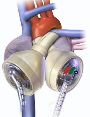 医疗设备公司：SynCardia Systems(TAHT)-图片2